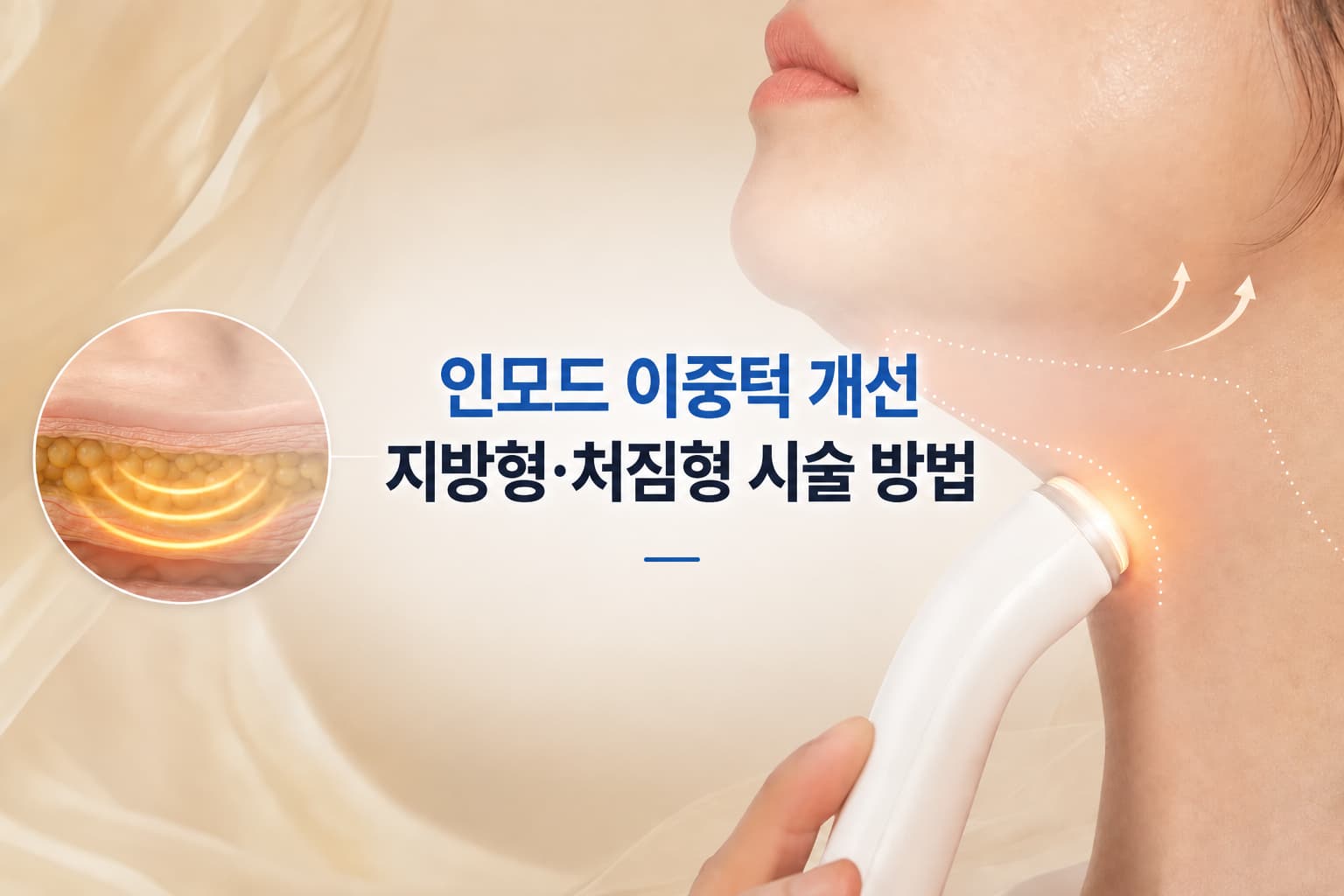 인모드 이중턱 개선 효과와 지방형_처짐형에 따른 시술 방법