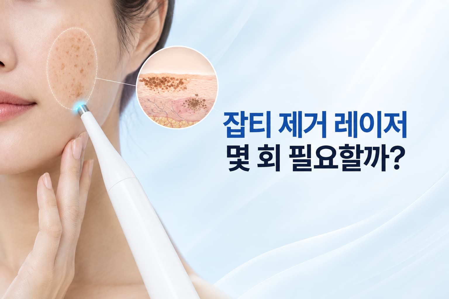 잡티 제거 레이저 몇 회 필요할까_색소 깊이별 치료 횟수와 간격