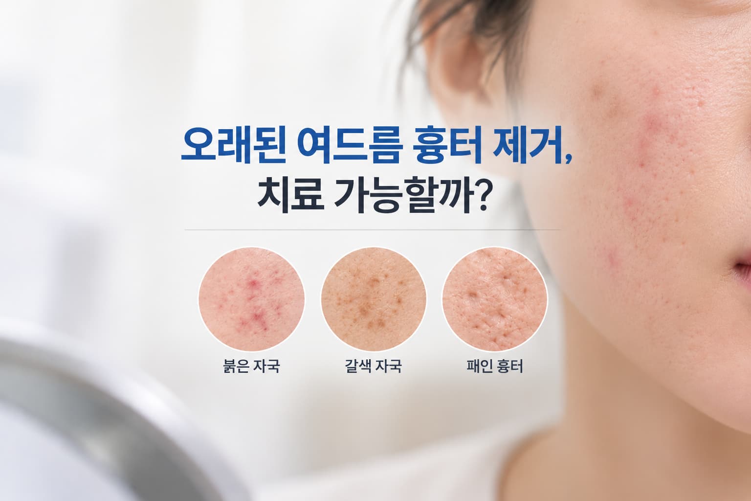 오래된 여드름흉터제거 방법은_유형별 치료 방법과 회복 과정