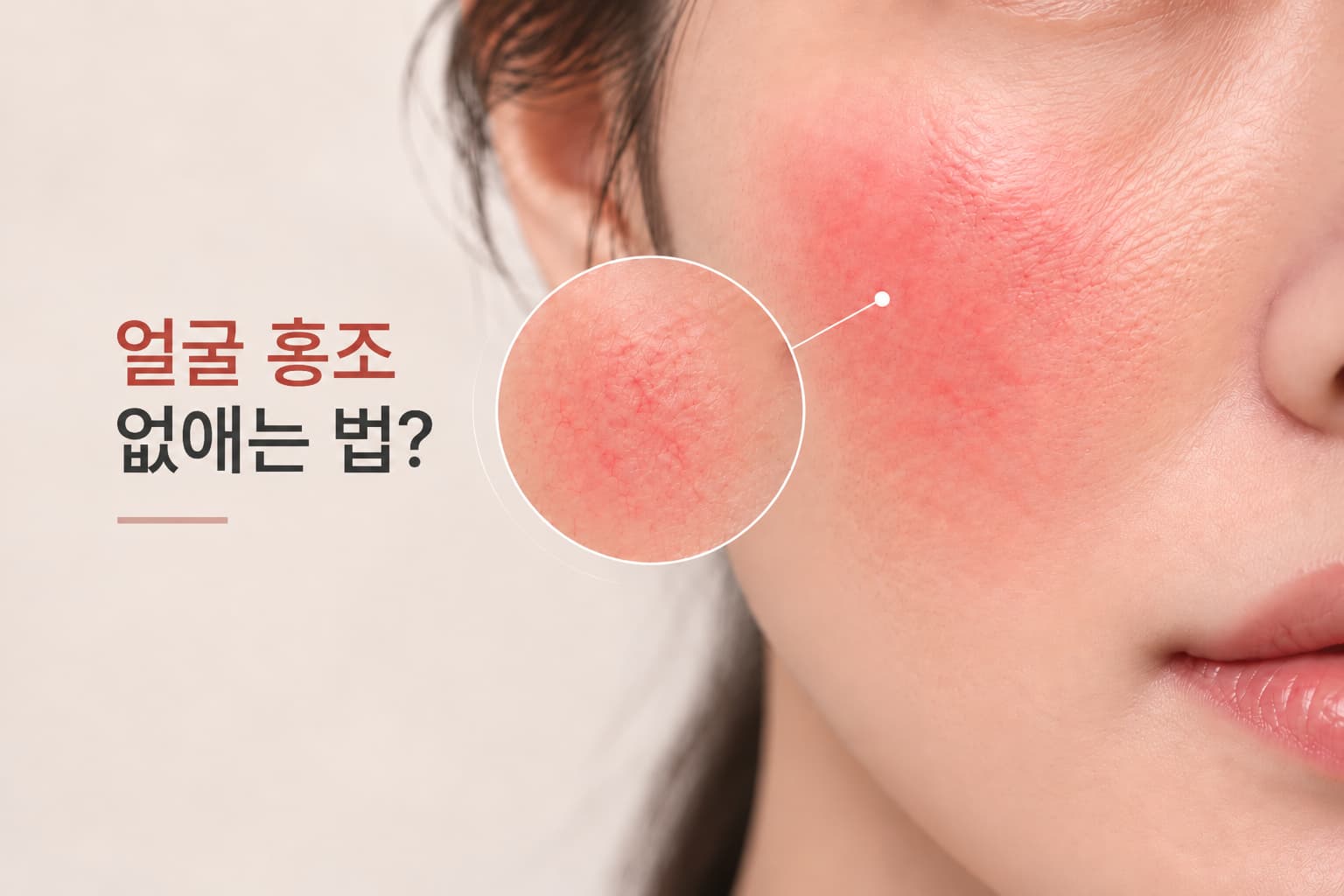 법-안면-홍조-유형 얼굴 홍조 없애는 법_치료 전 안면 홍조 유형부터 구분해야 하는 이유
