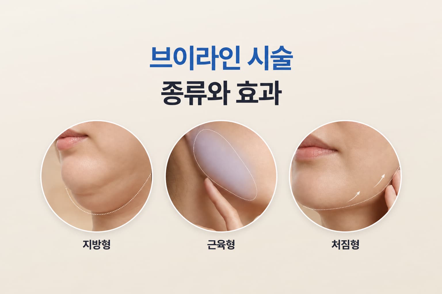 브이라인 시술 종류와 효과_턱선 개선을 위한 선택 기준